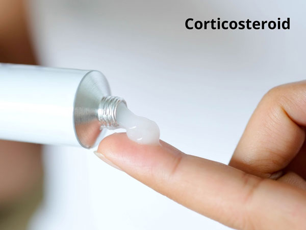 Corticosteroid là thuốc bôi phổ biến dùng cho người bệnh chàm
